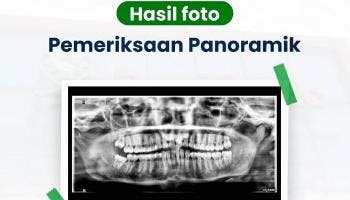 Kini rontgen gigi panoramic dan cephalometri  tersedia di laboratorium promedic,